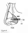 Fig. 08 - NASAL IMPLANT INTRODUCED THROUGH AN INJECTION TECHNIQUE
