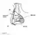 Fig. 09 - NASAL IMPLANT INTRODUCED THROUGH AN INJECTION TECHNIQUE