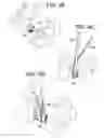 Fig. 04 - Minimally invasive corpectomy cage and instrument