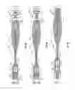 Fig. 06 - Interveterbral disc prosthesis insertion assemblies