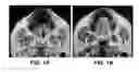 Fig. 02 - Devices and methods for treating sleep disordered breathing