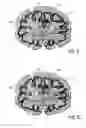 Fig. 08 - Transcranial magnetic stimulation field shaping