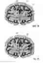 Fig. 09 - Transcranial magnetic stimulation field shaping