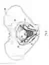 Fig. 06 - NEEDLE FOR SURGICAL THREADING AND METHOD FOR USING THE SAME