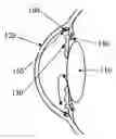 Fig. 01 - Intraocular pressure sensor