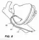 Fig. 04 - Multi-bend steerable mapping catheter