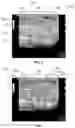 Fig. 06 - ULTRASOUND SYSTEM AND METHOD TO AUTOMATICALLY IDENTIFY AND TREAT ADIPOSE TISSUE