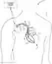 Fig. 01 - Detecting electrical conduction abnormalities in a heart