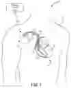 Fig. 02 - Detecting electrical conduction abnormalities in a heart