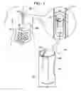 Fig. 02 - GASTRIC ANCHOR