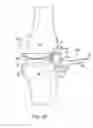 Fig. 06 - BONE RESECTION APPARATUS AND METHOD FOR KNEE SURGERY