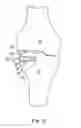 Fig. 07 - BONE RESECTION APPARATUS AND METHOD FOR KNEE SURGERY