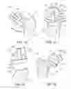 Fig. 06 - Patient specific alignment guide for a proximal femur
