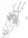 Fig. 03 - DISTRACTION TOOL FOR DISTRACTING AN INTERSPINOUS SPACE