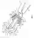 Fig. 04 - DISTRACTION TOOL FOR DISTRACTING AN INTERSPINOUS SPACE