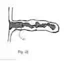 Fig. 08 - Devices, systems, and methods for percutaneous trans-septal left atrial appendage occlusion