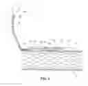 Fig. 06 - Radially Expandable Gastrointestinal Stimulation Device