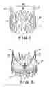 Fig. 02 - System For Implanting a Valve Prosthesis