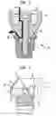 Fig. 03 - Percutaneous bone conduction implant