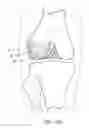 Fig. 04 - Stable cartilage defect repair plug