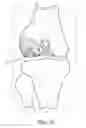 Fig. 06 - Stable cartilage defect repair plug