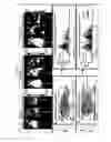 Fig. 06 - WNT PATHWAY MUTATIONS IN CANCER STEM CELLS