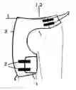 Fig. 01 - Hip brace and hip brace kit