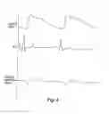 Fig. 02 - Pulse detection method and apparatus using patient impedance