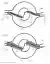 Fig. 09 - Endovascular router device and method