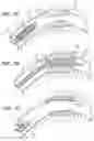 Fig. 02 - Bioerodible Endoprosthesis