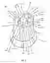 Fig. 08 - Device for compressing a stent
