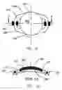 Fig. 06 - Refractive intraocular implant lens and method