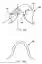 Fig. 07 - Refractive intraocular implant lens and method
