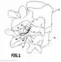 Fig. 02 - Facet joint implant