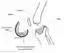 Fig. 01 - Method forming a one-piece articulating spacing device for a knee joint