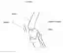 Fig. 03 - Method forming a one-piece articulating spacing device for a knee joint
