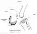 Fig. 04 - Method forming a one-piece articulating spacing device for a knee joint