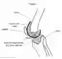 Fig. 05 - Method forming a one-piece articulating spacing device for a knee joint