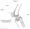 Fig. 06 - Method forming a one-piece articulating spacing device for a knee joint