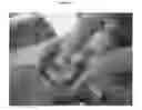 Fig. 08 - Method forming a one-piece articulating spacing device for a knee joint