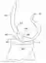 Fig. 01 - Systems and methods for providing deeper knee flexion capabilities for knee prosthesis patients