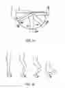 Fig. 02 - Systems and methods for providing deeper knee flexion capabilities for knee prosthesis patients
