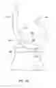 Fig. 30 - Systems and methods for providing deeper knee flexion capabilities for knee prosthesis patients