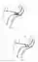 Fig. 09 - Occlusion of fallopian tubes in a vertebrate subject