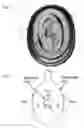 Fig. 02 - Wireless earplug with improved sensitivity and form factor