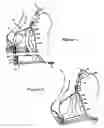 Fig. 02 - Halter bra
