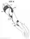 Fig. 04 - Wrist rotation controller for bowlers
