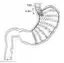 Fig. 01 - SATIATION DEVICES AND METHODS