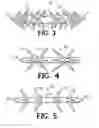 Fig. 03 - SUTURE WITH A POINTED END AND AN ANCHOR END AND WITH EQUALLY SPACED TISSUE GRASPING PROTRUSIONS LOCATED AT SUCCESSIVE AXIAL LOCATIONS