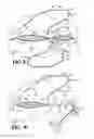 Fig. 03 - Methods for using self-retaining sutures in endoscopic procedures